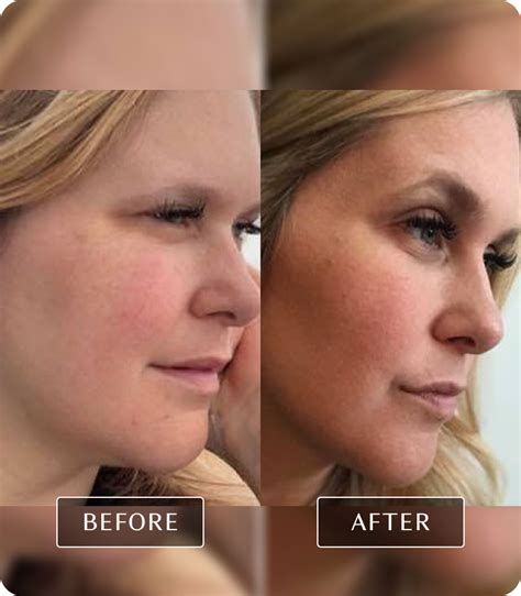 fascia blaster results|Fascia blasting: The real science behind the trend .